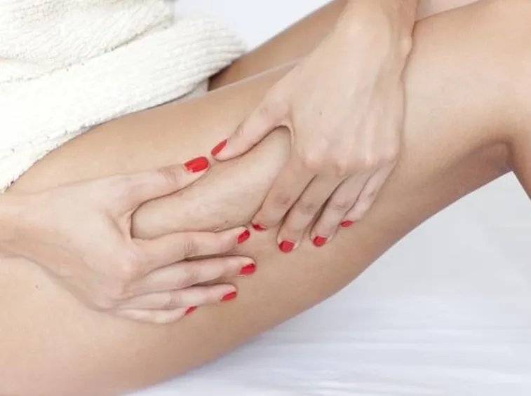 cellulite