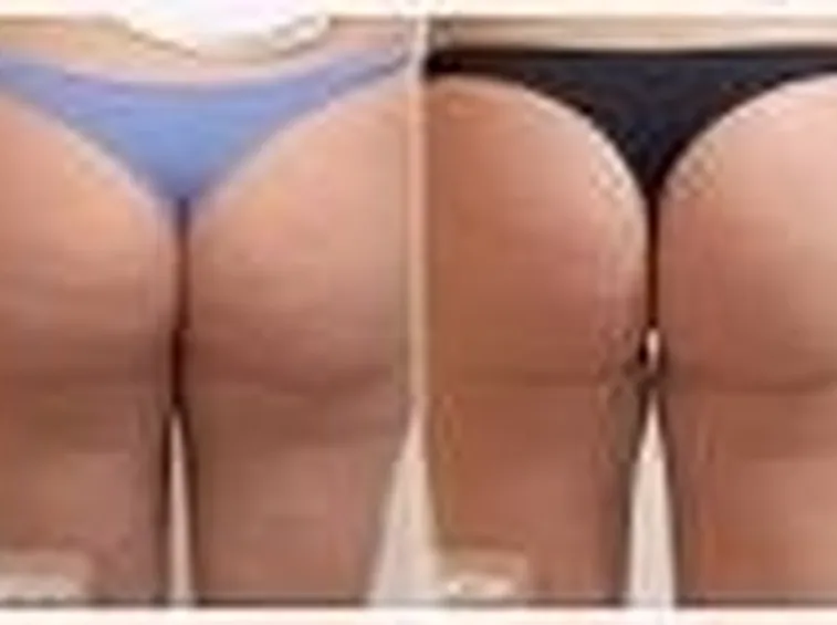 Cellulite