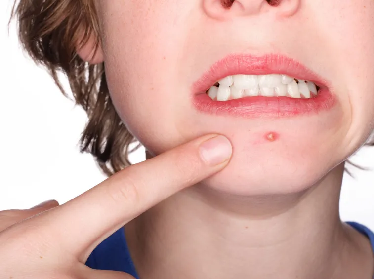 L'olio essenziale di tea tree nella cura dell'acne